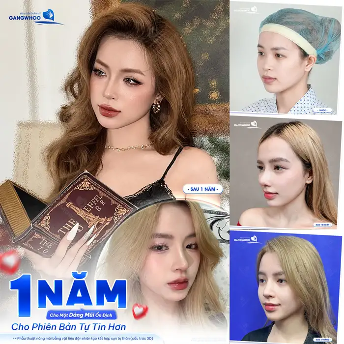 NÂNG MŨI CẤU TRÚC CHỈNH HÌNH TOÀN DIỆN KIẾN TẠO DÁNG MŨI HÀI HÒA