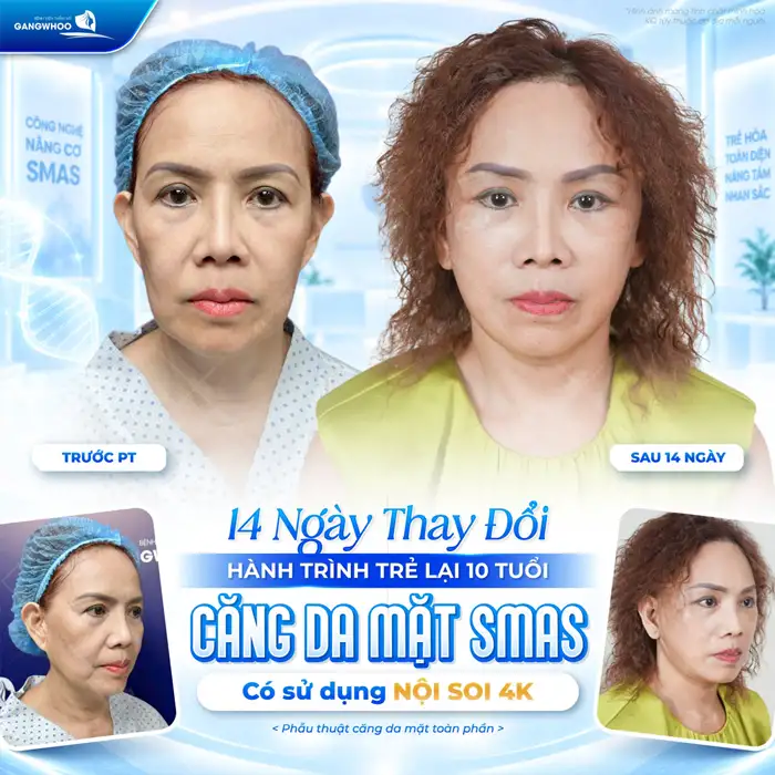 Căng Da Mặt Toàn Phần Giữ Mãi Tuổi Thanh Xuân Trên Gương Mặt Dài Lâu