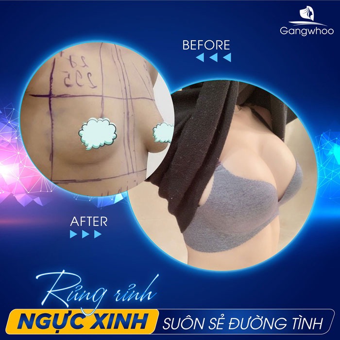 Hình ảnh thực tế trước và sau khách hàng cải thiện sau 1 tháng nâng ngực Ergonomix tại bệnh viện Gangwhoo