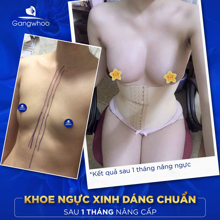 Hình ảnh thực tế vòng 1 khách hàng cải thiện sau 1 tháng nâng ngực Ergonomix tại bệnh viện Gangwhoo