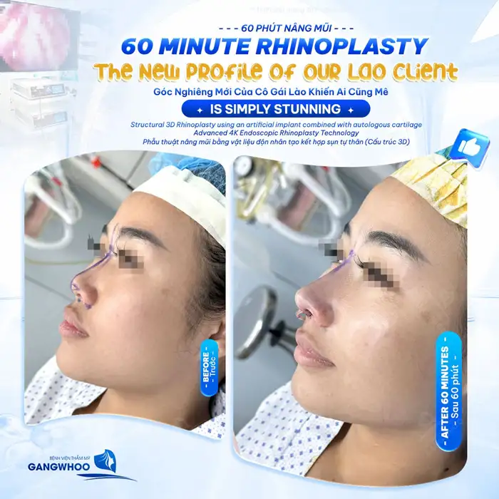 Nâng Mũi Cấu Trúc Đẹp Toàn Diện