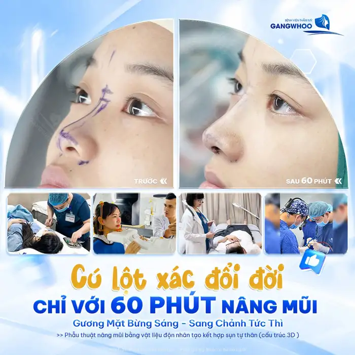 Nâng Mũi Hàn Quốc Tạo Dáng Mũi Cao, Đẹp Như Sao “Hàn”