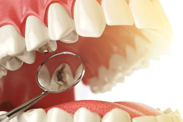 Kiểm tra sơ bộ và đánh giá tình trạng răng trước khi tiến hành trám răng