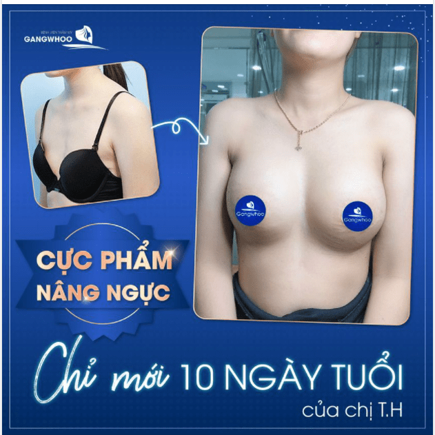 Hình ảnh thực tế khách hàng nâng ngực Ergonomix tại bệnh viện Gangwhoo