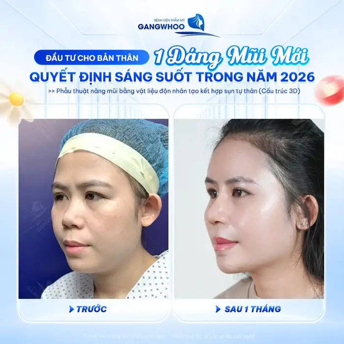 Nâng Mũi Hàn Quốc Tạo Dáng Mũi Cao, Đẹp Như Sao “Hàn”