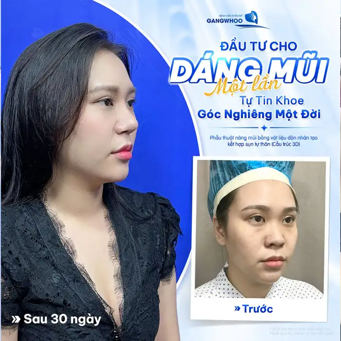 Nâng Mũi Cấu Trúc Đẹp Toàn Diện