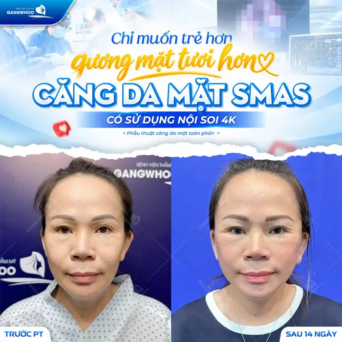 Căng Da Mặt Nội Soi Ở Đâu Uy Tín?