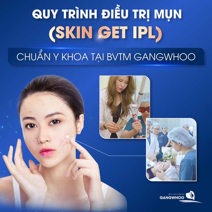 Quy trình điều trị mụn (skin get IPL)