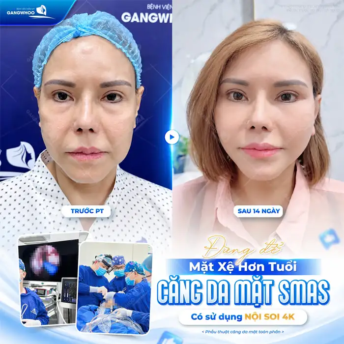 Căng Da Mặt Nội Soi Ở Đâu Uy Tín?
