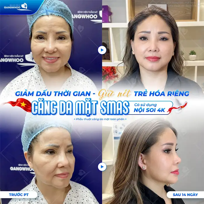 Căng Da Mặt Nội Soi Ở Đâu Uy Tín?