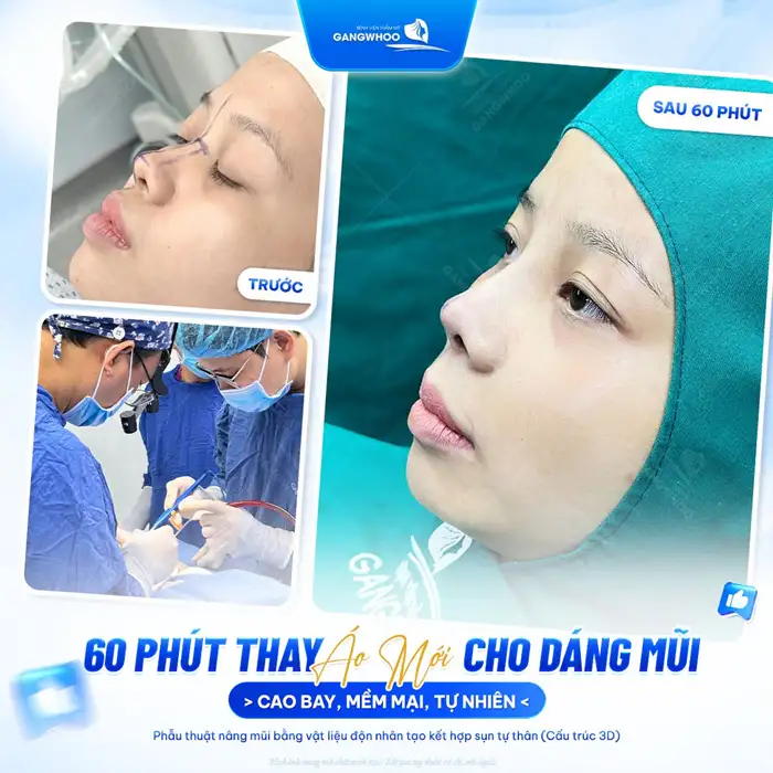 Nâng Mũi Hàn Quốc Tạo Dáng Mũi Cao, Đẹp Như Sao “Hàn”
