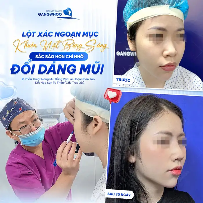 Nâng Mũi Cấu Trúc Đẹp Toàn Diện