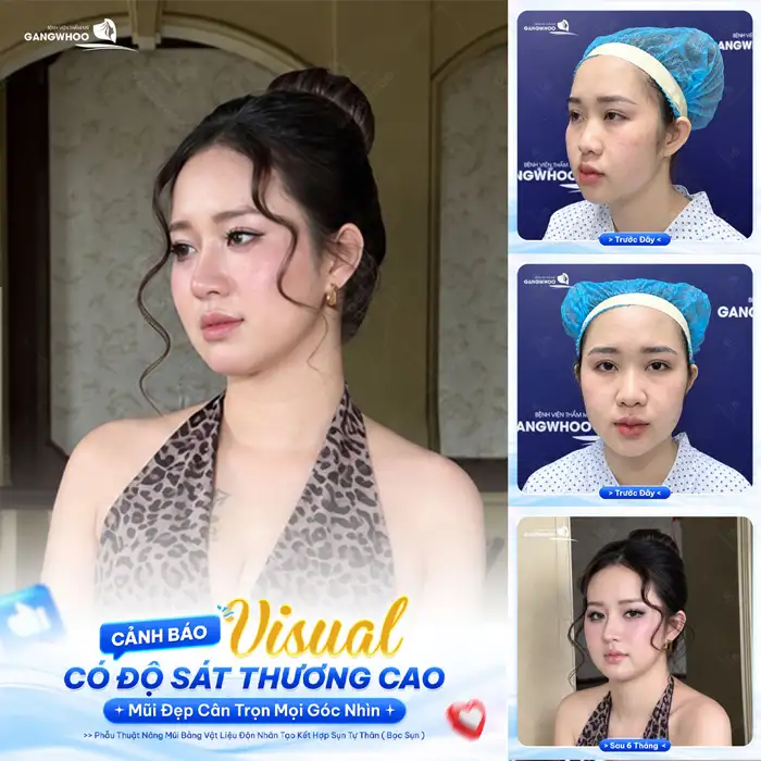 Nâng Mũi Hàn Quốc Tạo Dáng Mũi Cao, Đẹp Như Sao “Hàn”