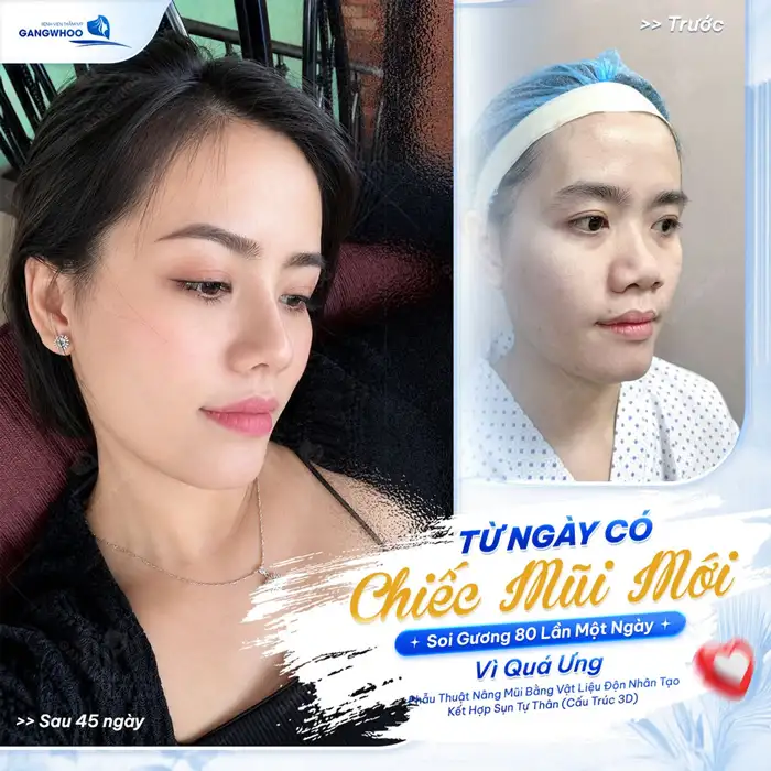Nâng Mũi Hàn Quốc Tạo Dáng Mũi Cao, Đẹp Như Sao “Hàn”