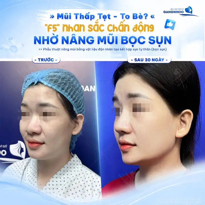 Nâng mũi bọc sụn tự thân tạo dáng mũi cao thanh thoát