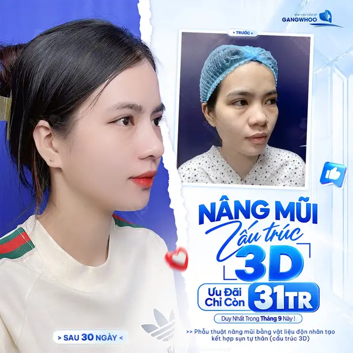 Nâng Mũi Cấu Trúc Đẹp Toàn Diện
