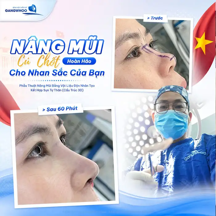 Nâng mũi bọc sụn tự thân tạo dáng mũi cao thanh thoát