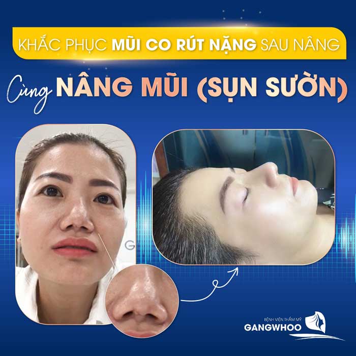 Hình ảnh thực tế Chị Thúy nâng mũi sụn sườn tại bệnh viện Gangwhoo