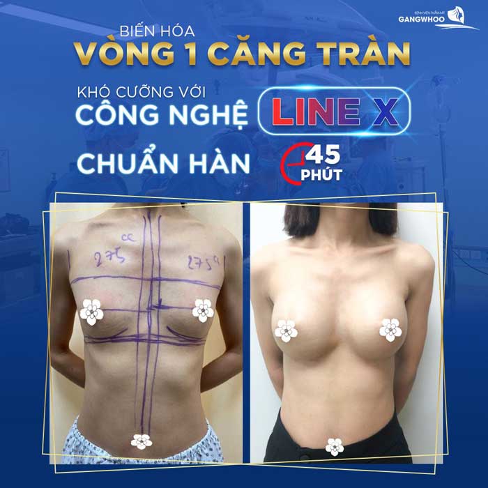 Hình ảnh thực tế Chị Ngọc nâng ngực Line X tại bệnh viện Gangwhoo