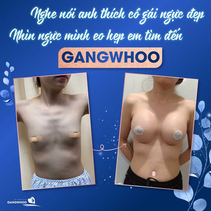 Hình ảnh thực tế cấy mỡ tự thân nâng cấp vòng 1 cho Chị Quỳnh tại bệnh viện Gangwhoo