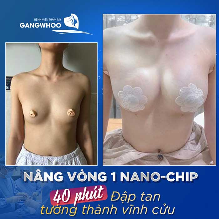 Hình ảnh thực tế khách hàng nâng ngực nội soi túi Nano Chip tại bệnh viện Gangwhoo