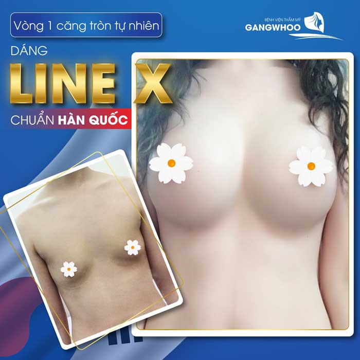 Hình ảnh thực tế Chị Thủy nâng ngực Line X tại bệnh viện Gangwhoo