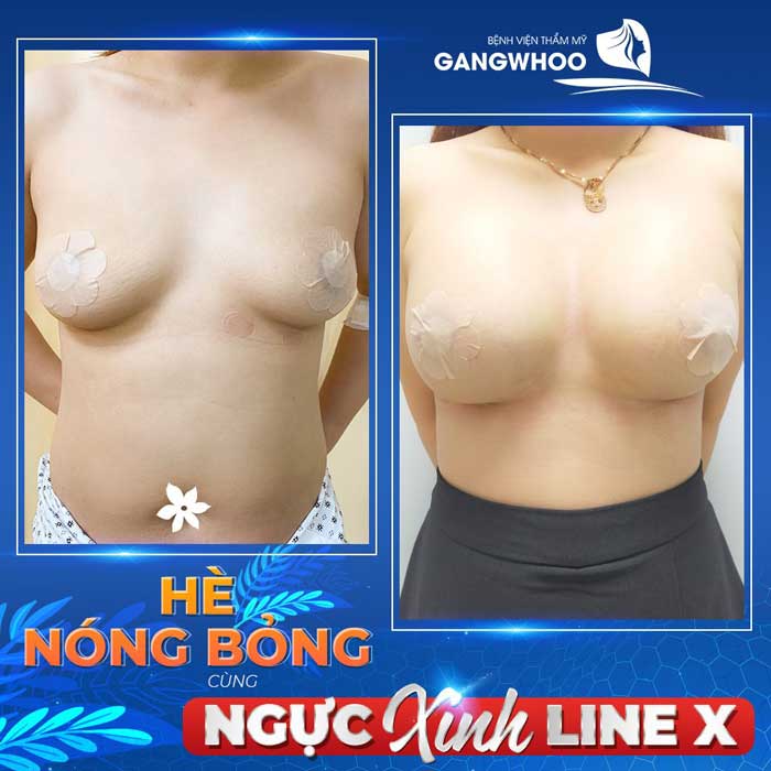 Hình ảnh thực tế Chị Hạnh nâng ngực Line X tại bệnh viện Gangwhoo