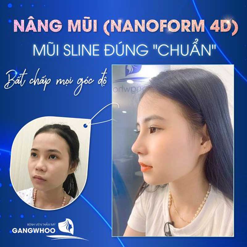 Hình ảnh thực tế nâng mũi Nanoform 4D cho Chị Thúy Anh tại bệnh viện Gangwhoo