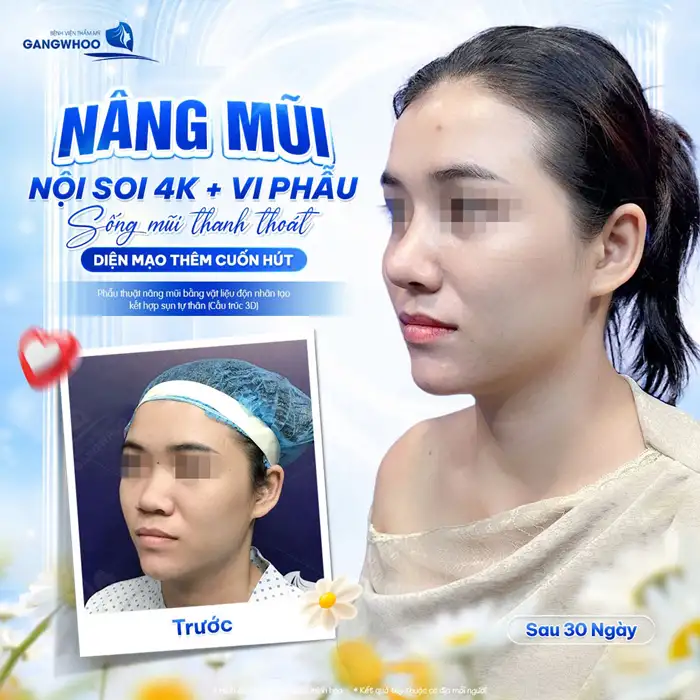 Nâng Mũi Sụn Tai Sinh Học – Công Nghệ Mới Cho Dáng Mũi