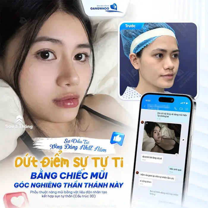 Nâng Mũi Cấu Trúc Đẹp Toàn Diện