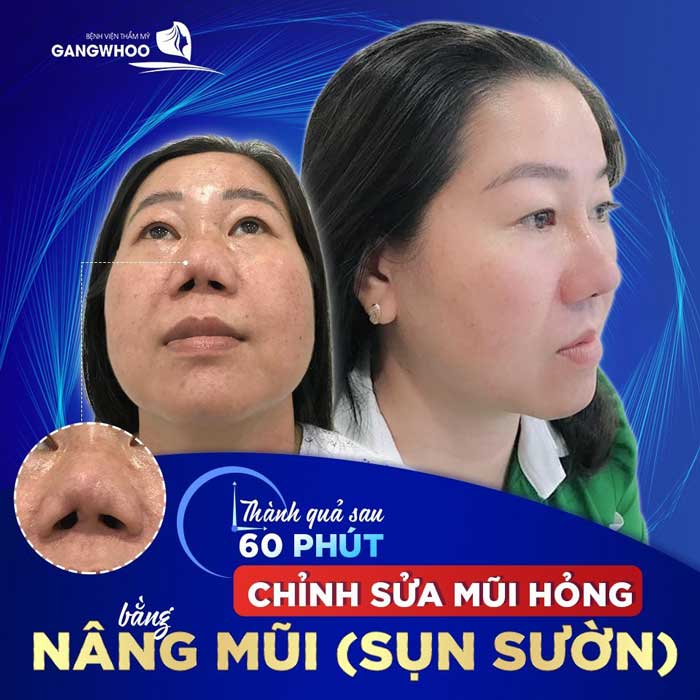 Hình ảnh thực tế Chị Hồng nâng mũi tại bệnh viện Gangwhoo