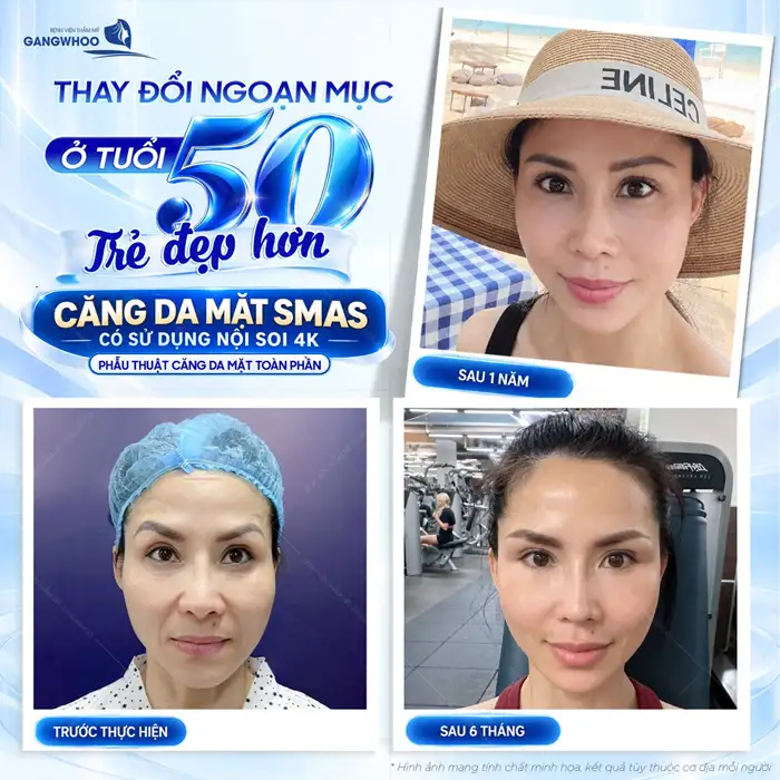 Căng Da Mặt Toàn Phần Giữ Mãi Tuổi Thanh Xuân Trên Gương Mặt Dài Lâu