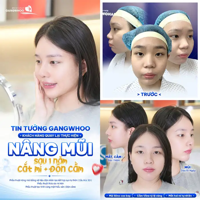 Nâng Mũi Cấu Trúc Đẹp Toàn Diện