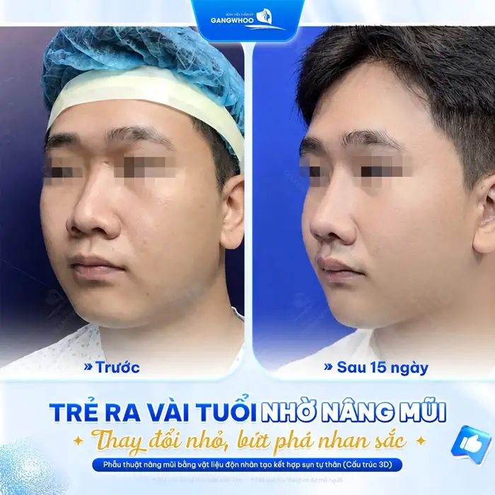 Nâng mũi bọc sụn tự thân tạo dáng mũi cao thanh thoát
