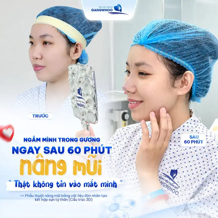 Nâng Mũi Cấu Trúc Đẹp Toàn Diện