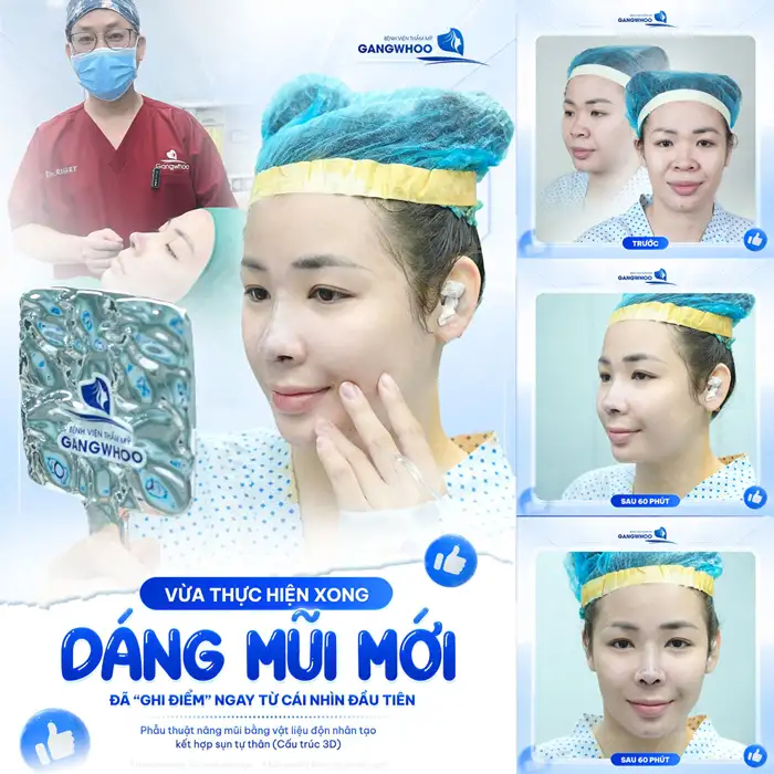 Nâng Mũi Cấu Trúc Đẹp Toàn Diện