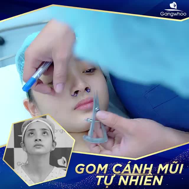 Hình ảnh thực tế Chị Minh thu gọn cánh mũi tại bệnh viện Gangwhoo