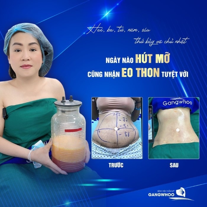 Hình ảnh thực tế Chị Loan giảm mỡ thừa vùng bụng tại bệnh viện Gangwhoo