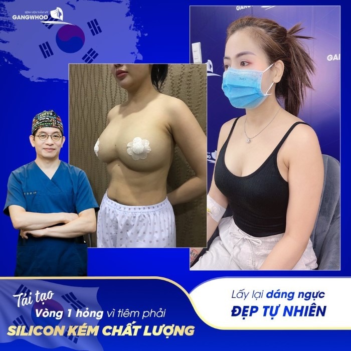 Hình ảnh thực tế khách hàng nâng ngực túi Arion tại bệnh viện Gangwhoo