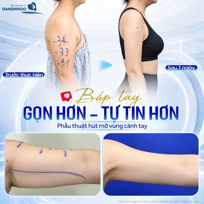 Hút Mỡ Cánh Tay – Giúp Lấy Lại Cánh Tay Thon Gọn, Săn Chắc