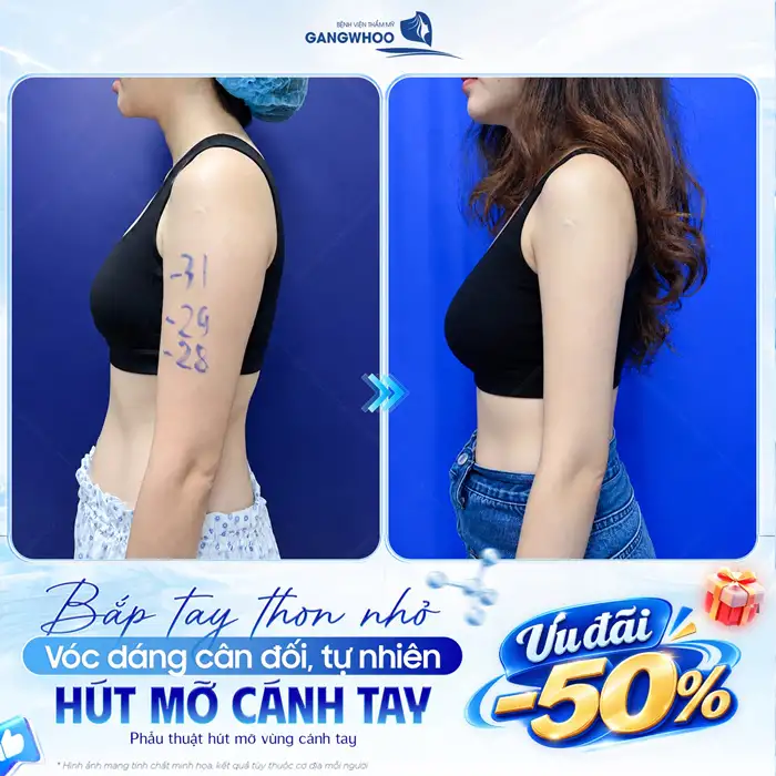 Hút Mỡ Cánh Tay – Giúp Lấy Lại Cánh Tay Thon Gọn, Săn Chắc