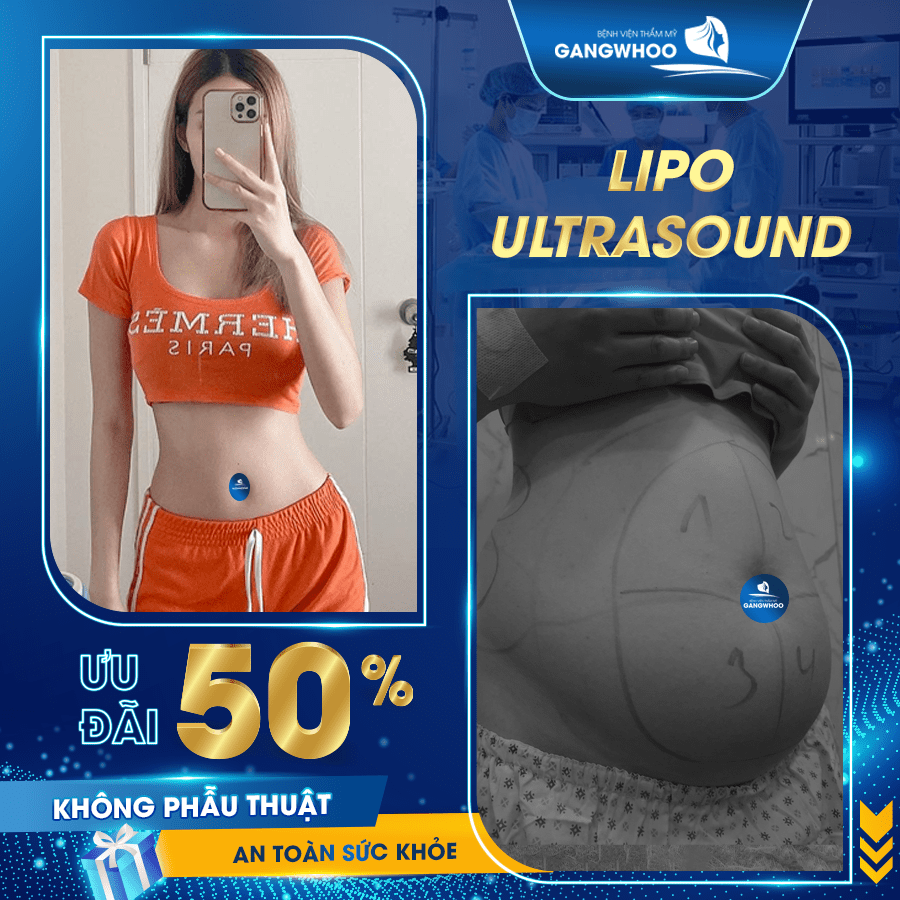 Dịch vụ giảm béo Lipo Ultrasound tại bệnh viện Gangwhoo an toàn, hiệu quả tốt nhất hiện nay