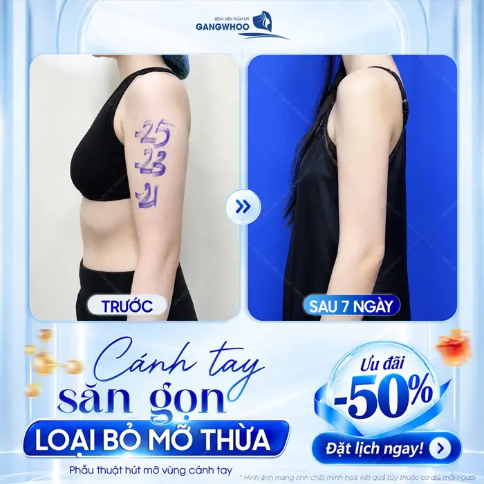 Hút Mỡ Cánh Tay – Giúp Lấy Lại Cánh Tay Thon Gọn, Săn Chắc