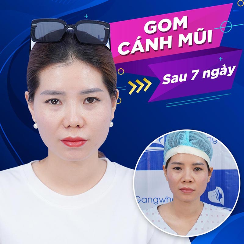 Cánh mũi thay đổi sau 7 ngày tại bệnh viện Gangwhoo