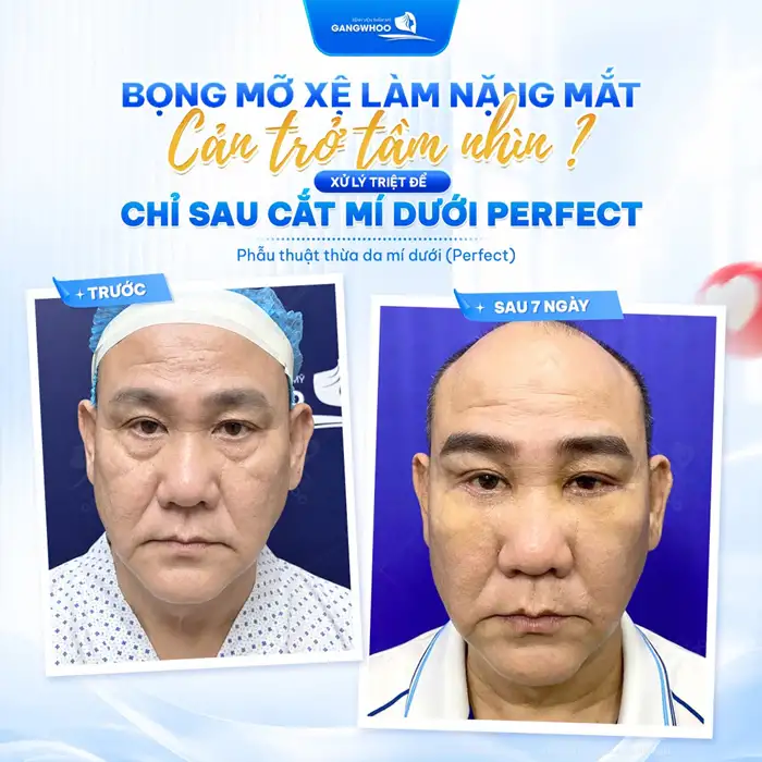Cắt Mí mắt Perfect giải pháp cho 2 mí đẹp chuẩn tự nhiên