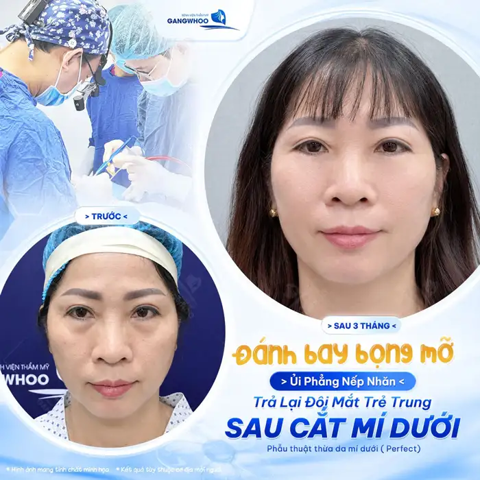 Cắt Mí mắt Perfect giải pháp cho 2 mí đẹp chuẩn tự nhiên