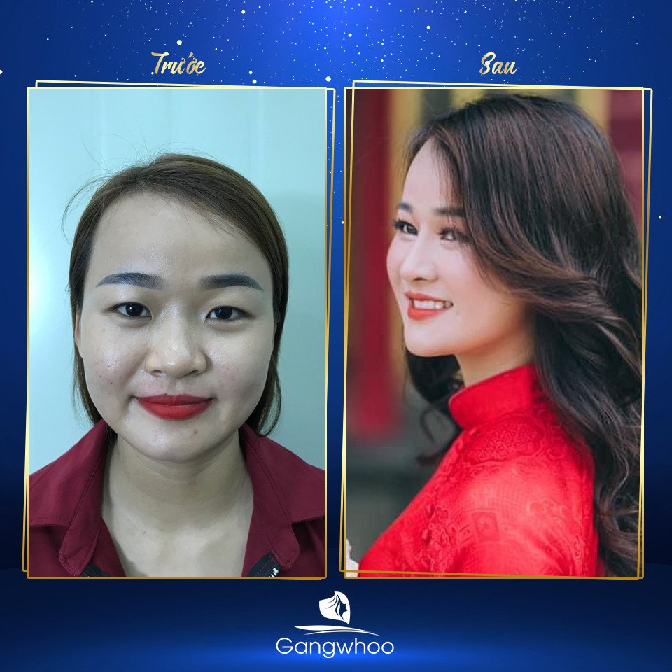 Hình ảnh trước và sau khách hàng thu nhỏ đầu mũi tại bệnh viện Gangwhoo