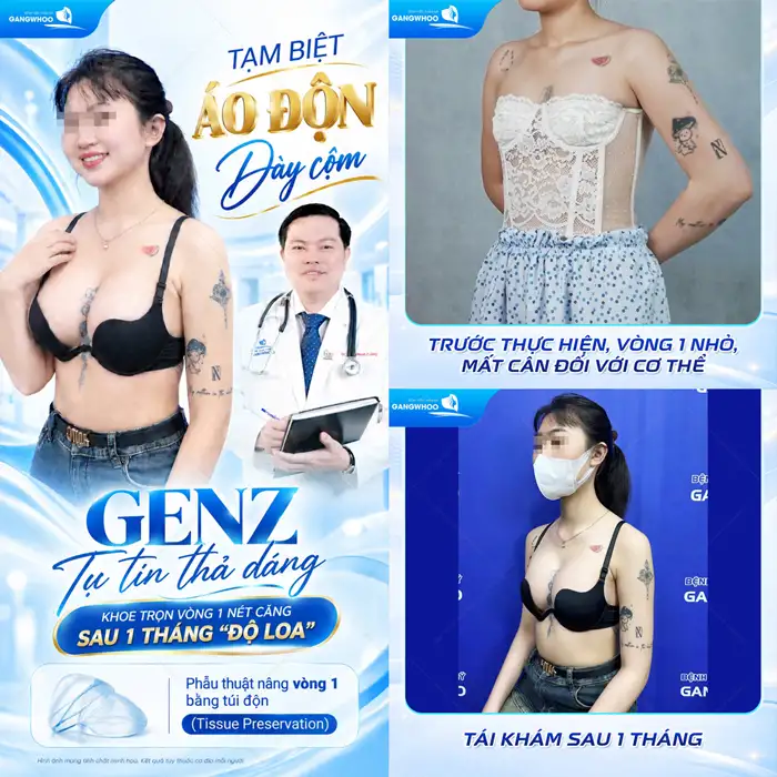 Nâng Ngực Nội Soi (Túi Nano Chip)