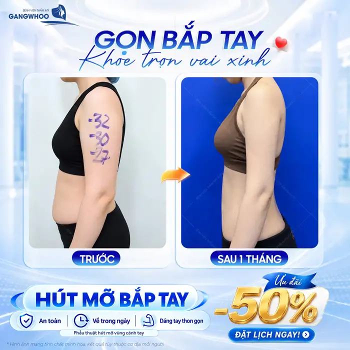 Hút Mỡ Cánh Tay – Giúp Lấy Lại Cánh Tay Thon Gọn, Săn Chắc
