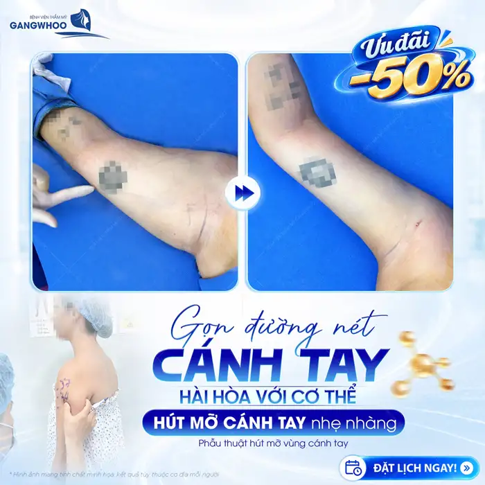 Hút Mỡ Cánh Tay – Giúp Lấy Lại Cánh Tay Thon Gọn, Săn Chắc